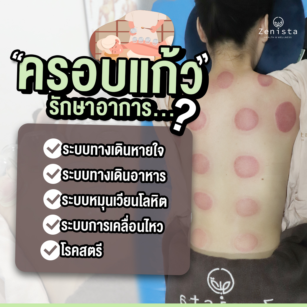 ครอบแก้ว กระตุ้นให้เกิดการไหลเวียนของเลือดลม