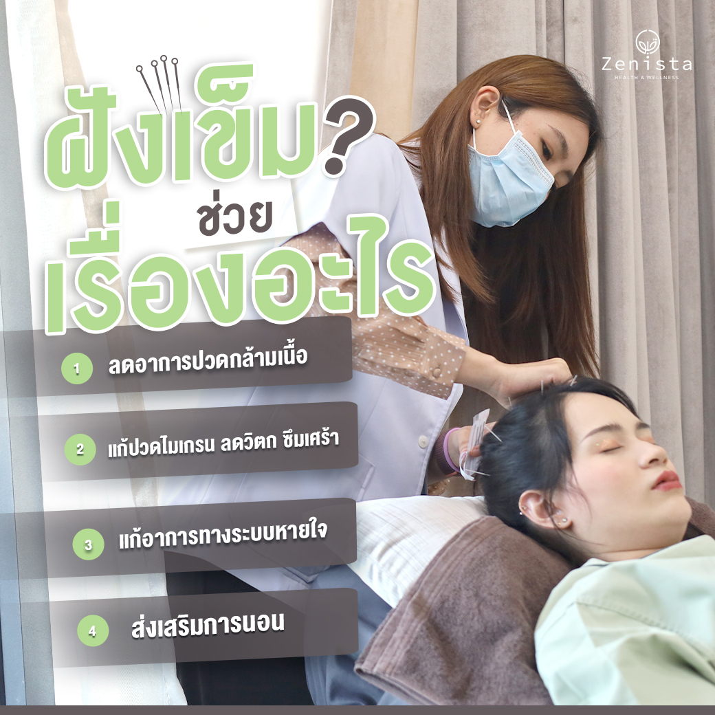 ฝังเข็ม Acupuncture